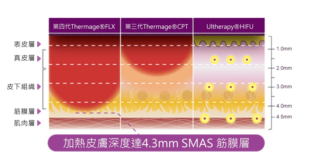 鳳凰電波作用深度探頭熱效應SMAS筋膜層