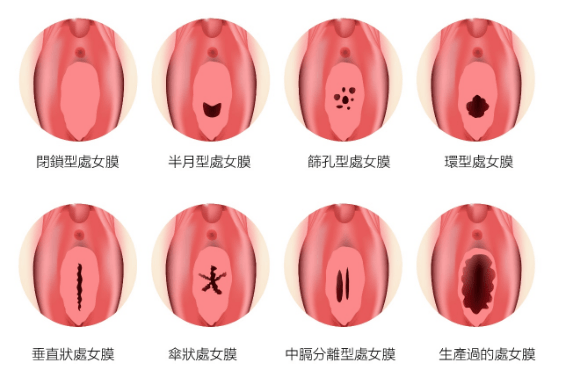 處女膜修補 靚優健康醫學美容診所