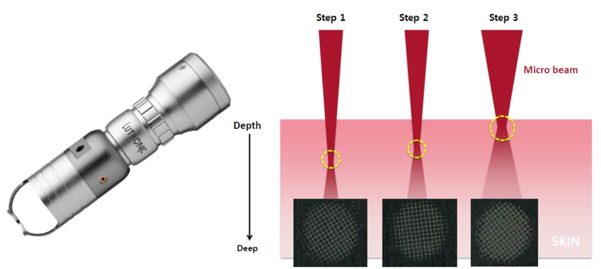 4D皮秒雷射 蜂巢探頭除毛孔痘疤黑色素刺青