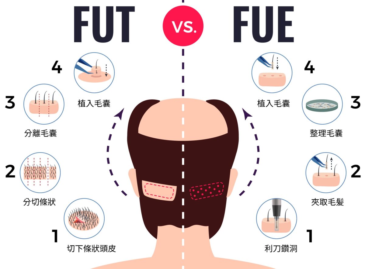 生髮植髮,靚優,鄭嘉琪,醫美診所,靚優醫美,
