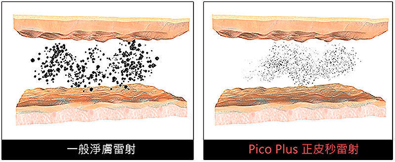 PicoPlus-pigment-tx,靚優,鄭嘉琪,醫美診所,皮秒雷射,將黑色素擊碎粉塵化