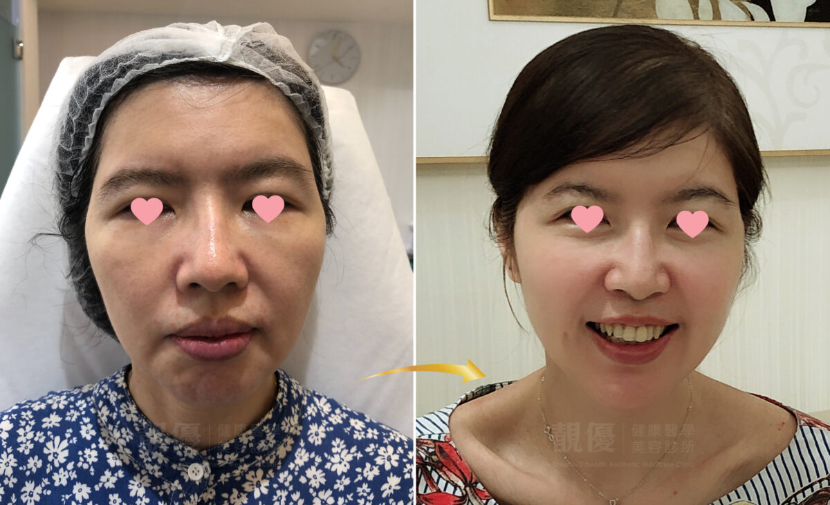 埋線拉提術前術後