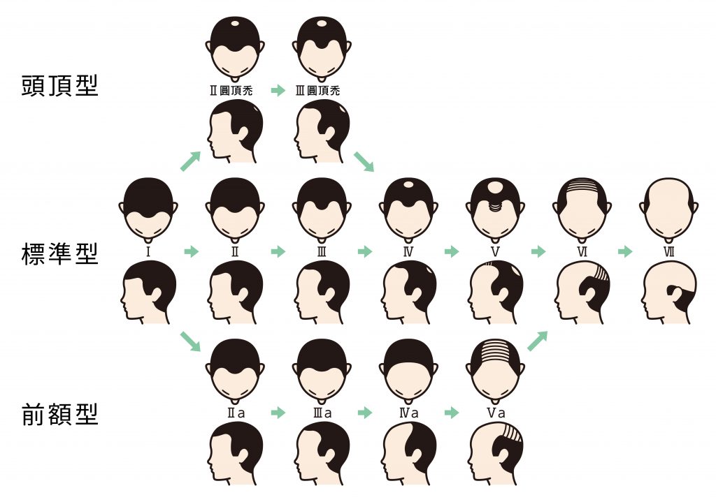 禿頭的各種類型男女落髮類型