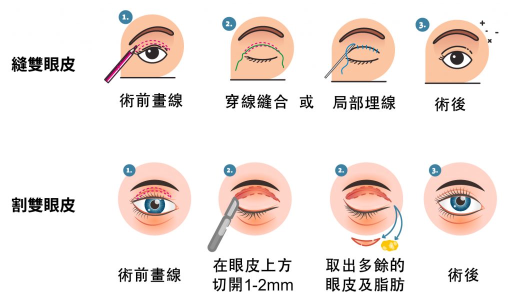 雙眼皮手術原理流程圖