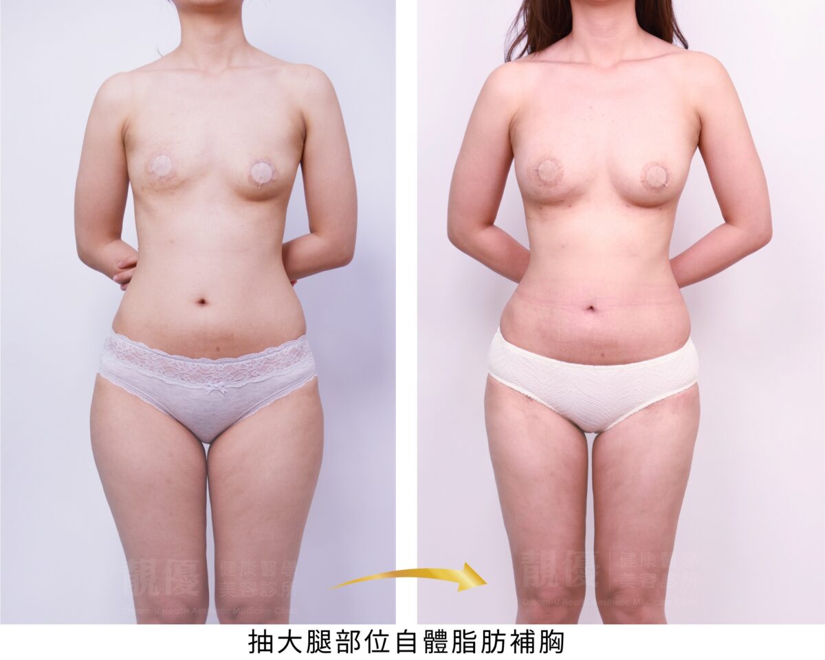 抽脂補胸術前術後3