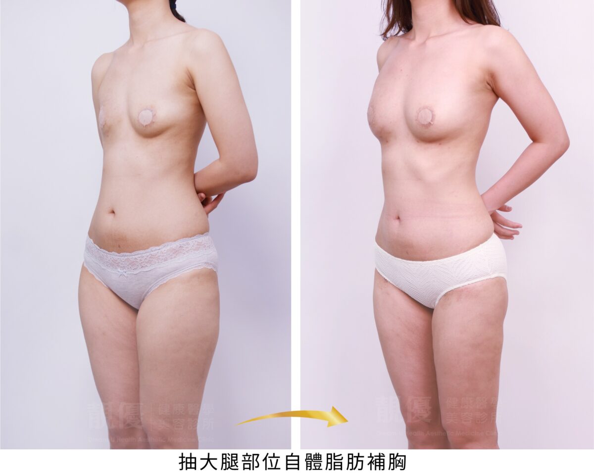 抽脂補胸優惠