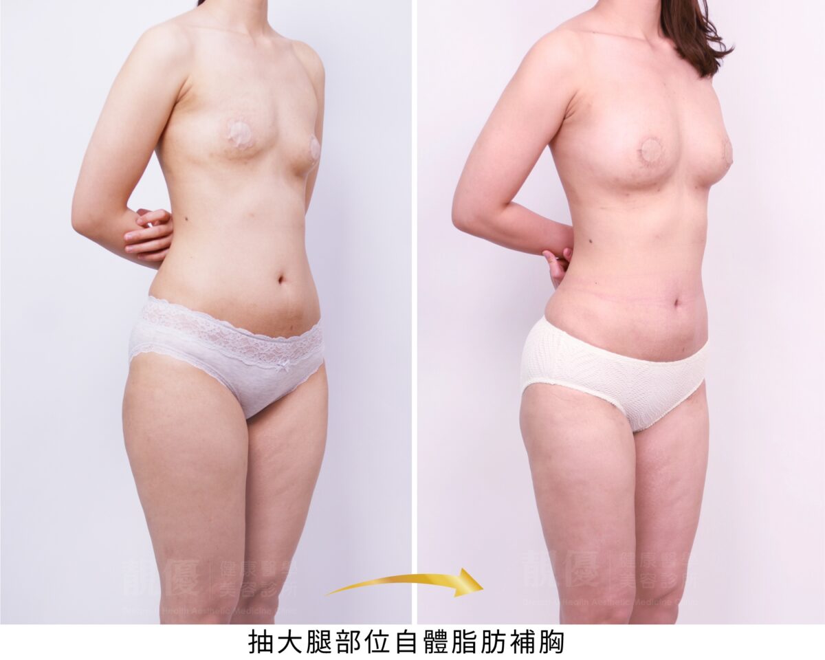 抽脂補胸術前術後2