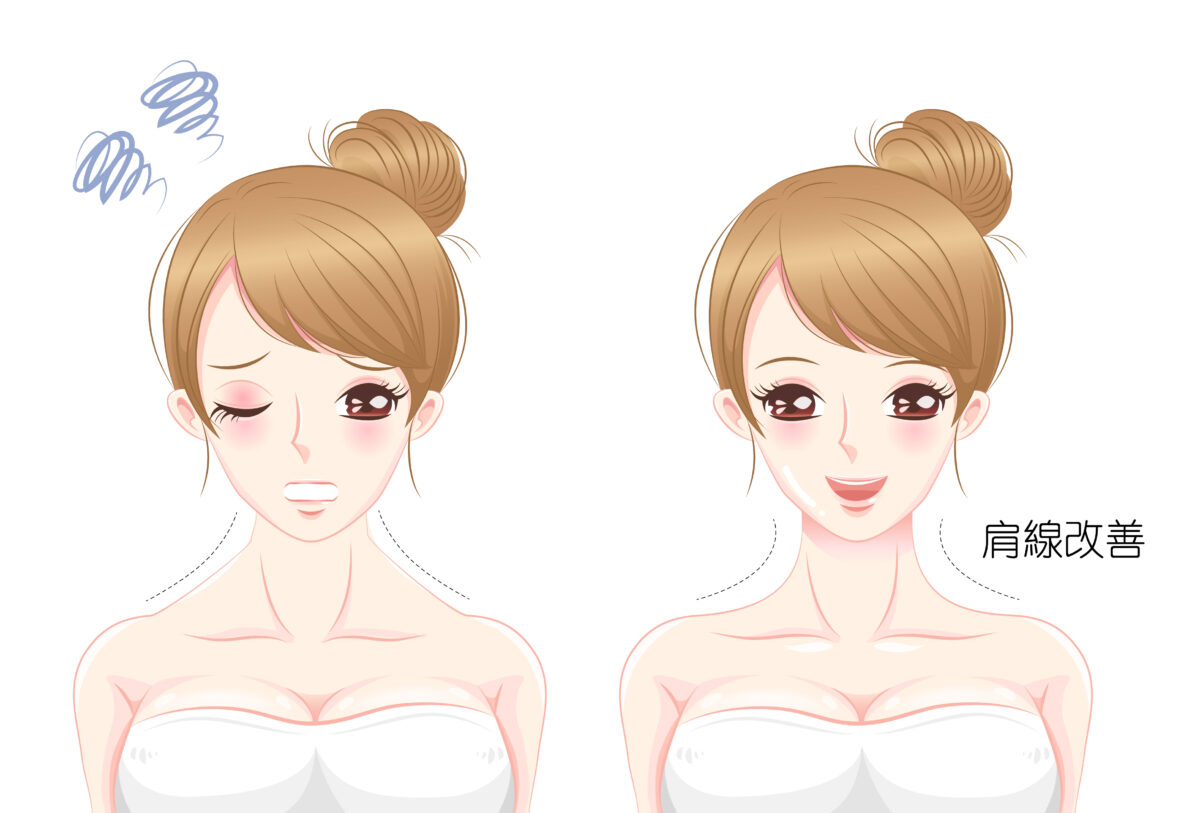 肉毒肩膀肌肉瘦肩針