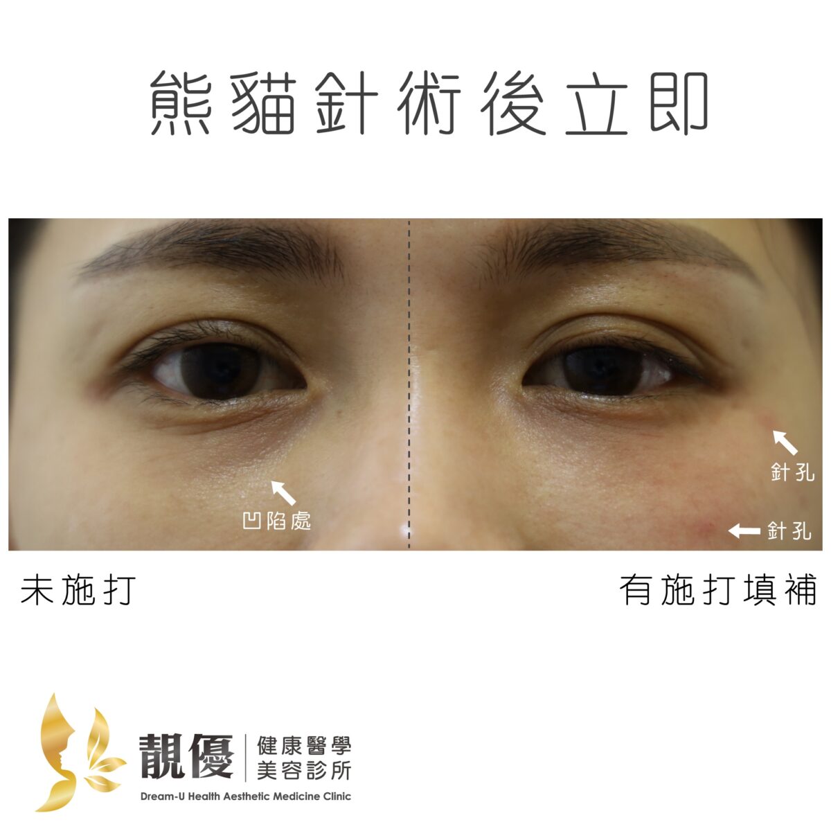 膠原蛋白熊貓針淚溝型黑眼圈術後立即對比