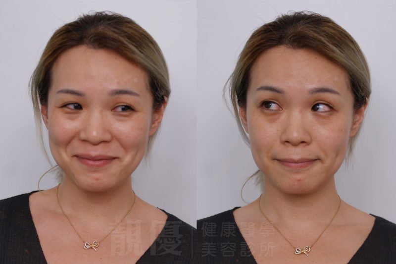 音波皮秒膠原蛋白熊貓針術前術後黑眼圈