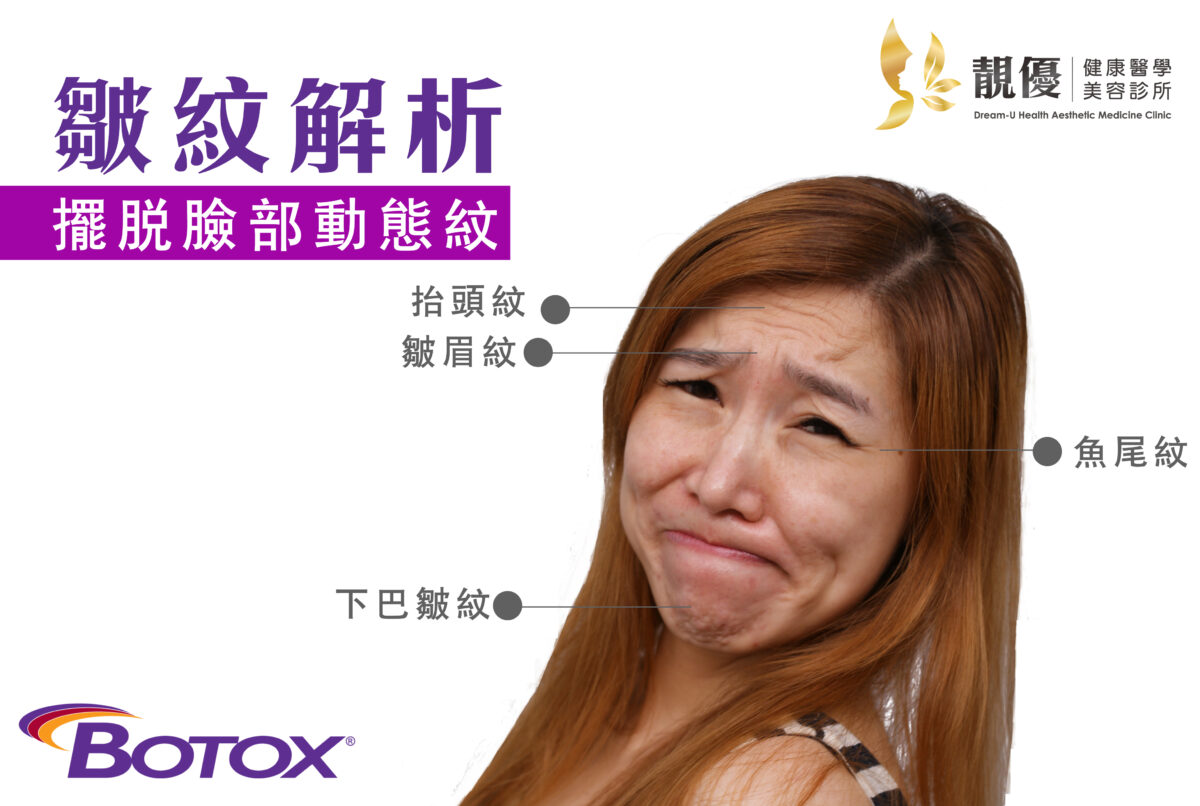 如何撒嬌肉毒除皺動態表情紋