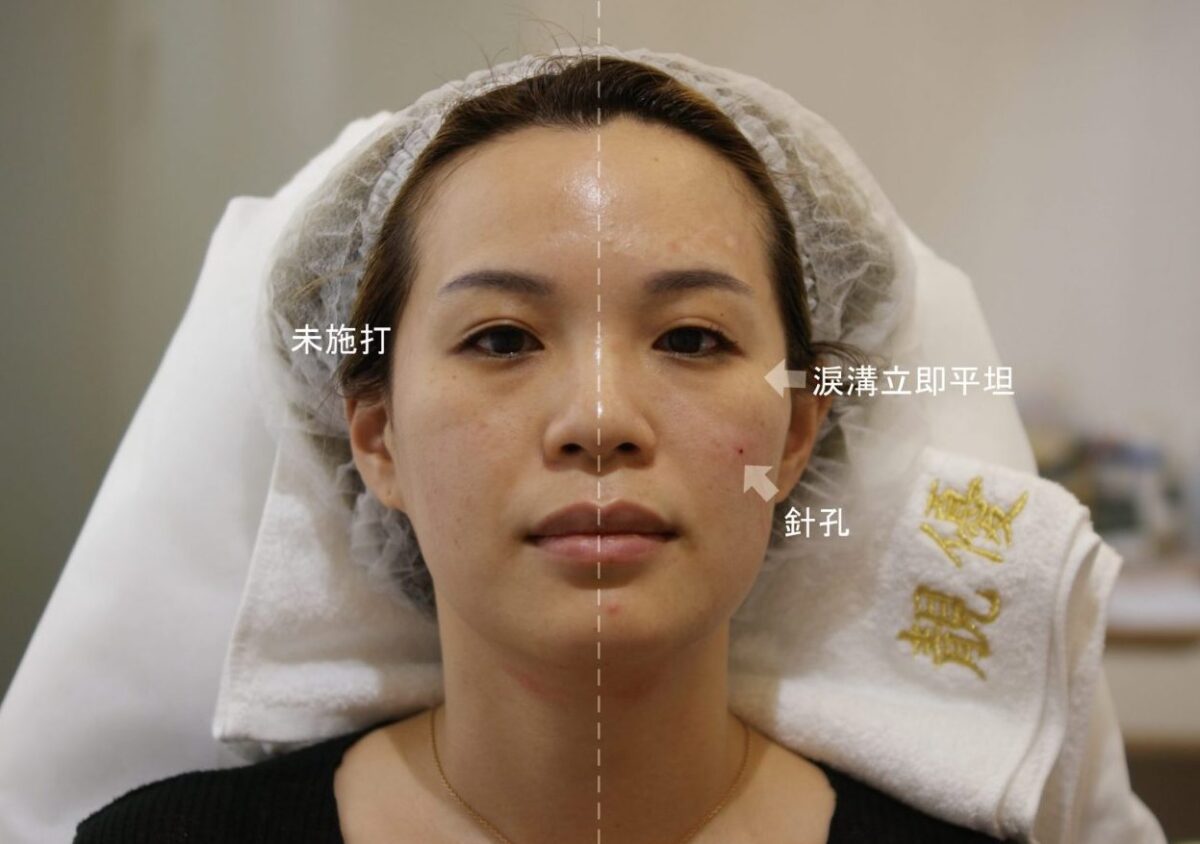 海芙音波拉提皮秒雷射膠原蛋白熊貓針黑眼圈淚溝術前術後