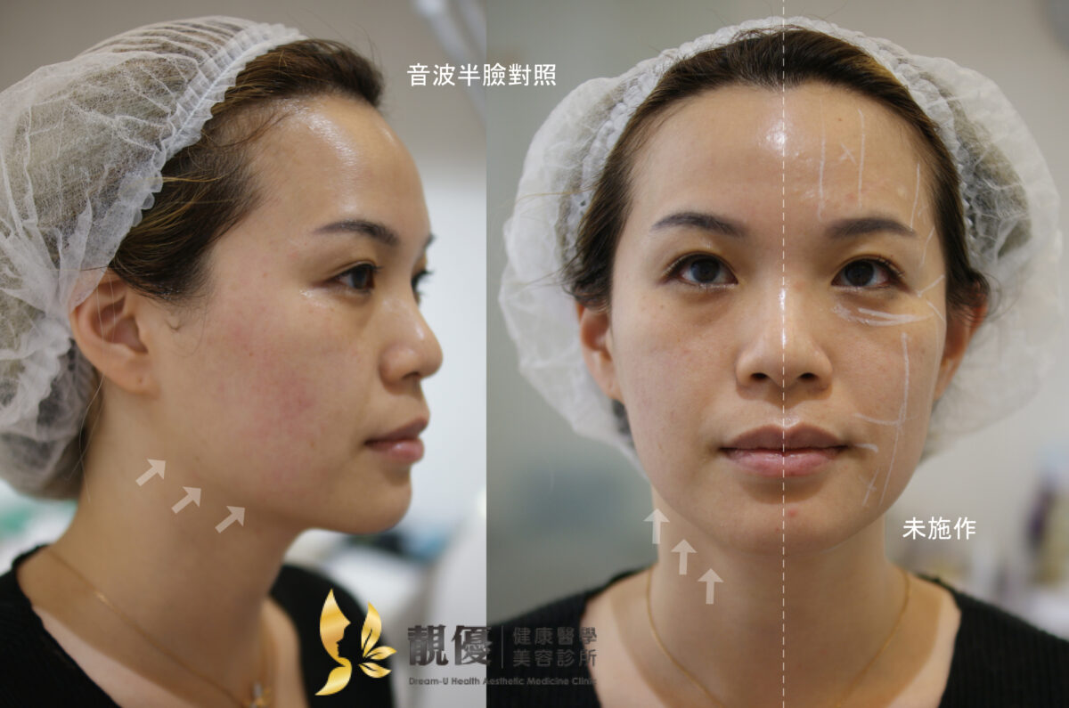 音波皮秒膠原蛋白熊貓針術前術後