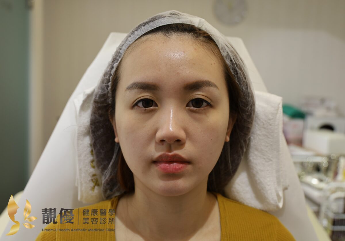 双美膠原蛋白熊貓針改善淚溝黑眼圈