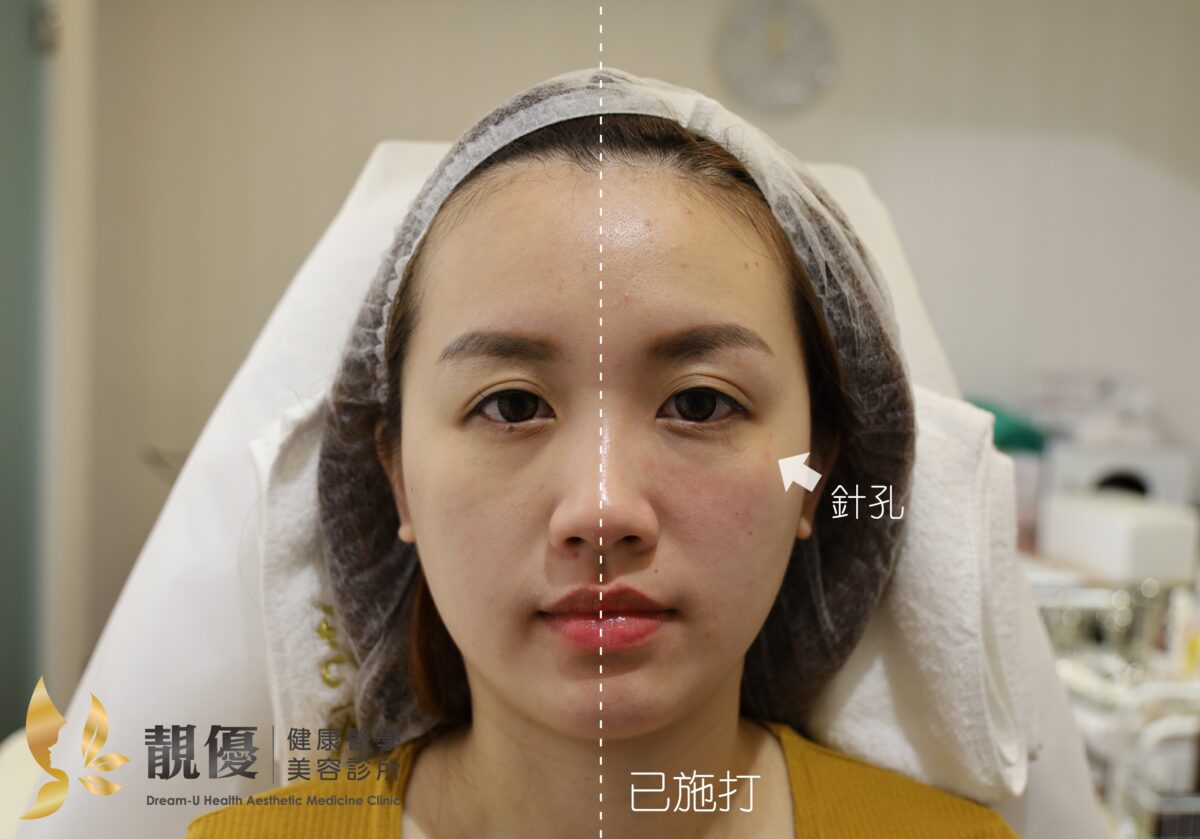 双美膠原蛋白熊貓針改善淚溝黑眼圈