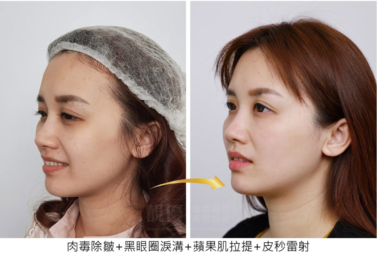 双美膠原蛋白熊貓針改善淚溝黑眼圈