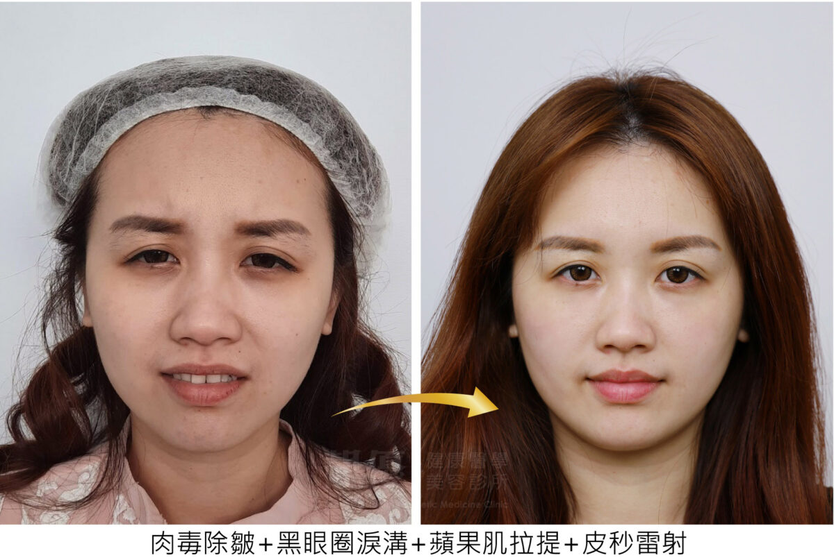 双美膠原蛋白熊貓針改善淚溝黑眼圈