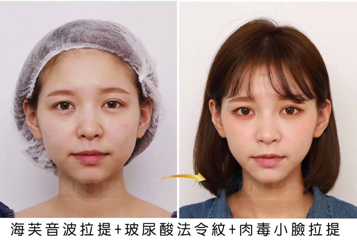 ULTRAFORMER-III海芙音波拉提,靚優,鄭嘉琪,醫美診所,靚優醫美,術前術後