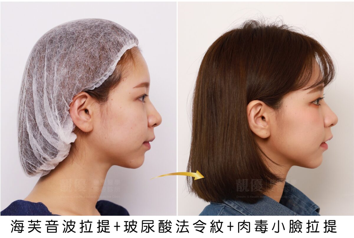 ULTRAFORMER-III海芙音波拉提,靚優,鄭嘉琪,醫美診所,靚優醫美,術前術後