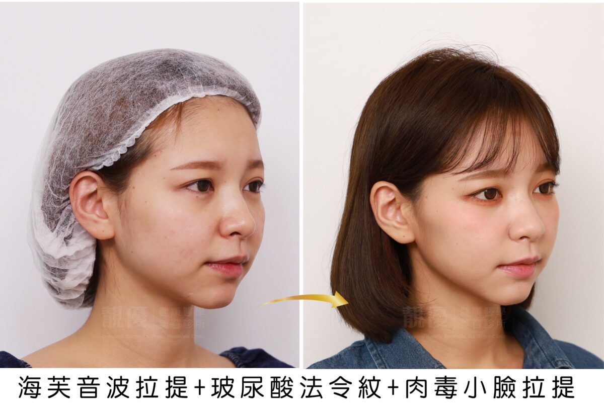 ULTRAFORMER-III海芙音波拉提,靚優,鄭嘉琪,醫美診所,靚優醫美,術前術後