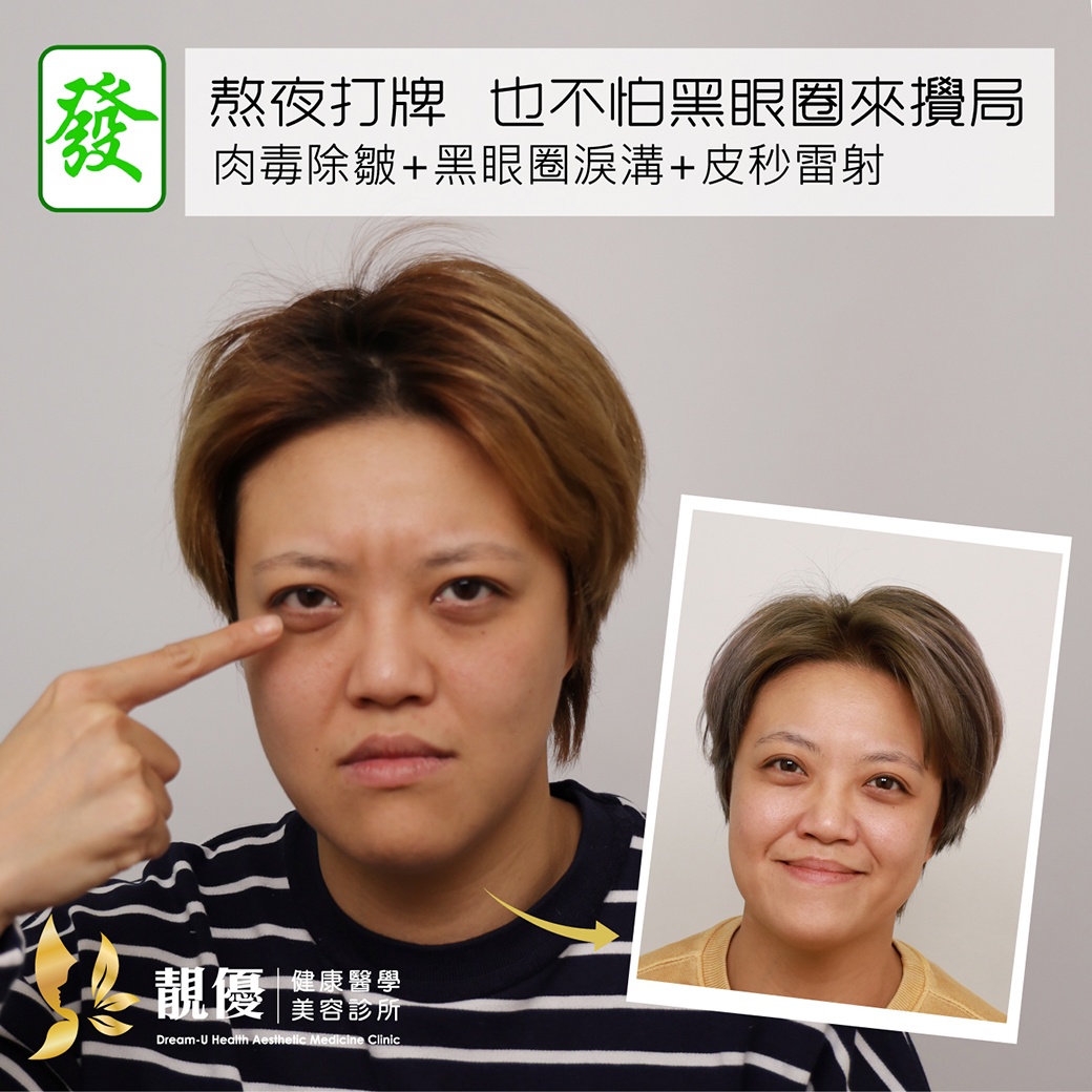 膠原蛋白,熊貓針,靚優,鄭嘉琪,醫美診所,靚優醫美,術前術後,台北推薦,東區醫美