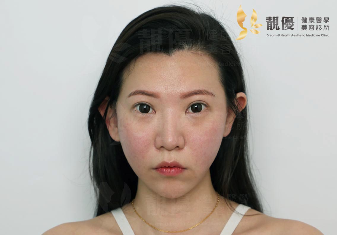 埋線拉提,靚優,鄭嘉琪,醫美診所,靚優醫美,藍鑽魚骨線,台北推薦