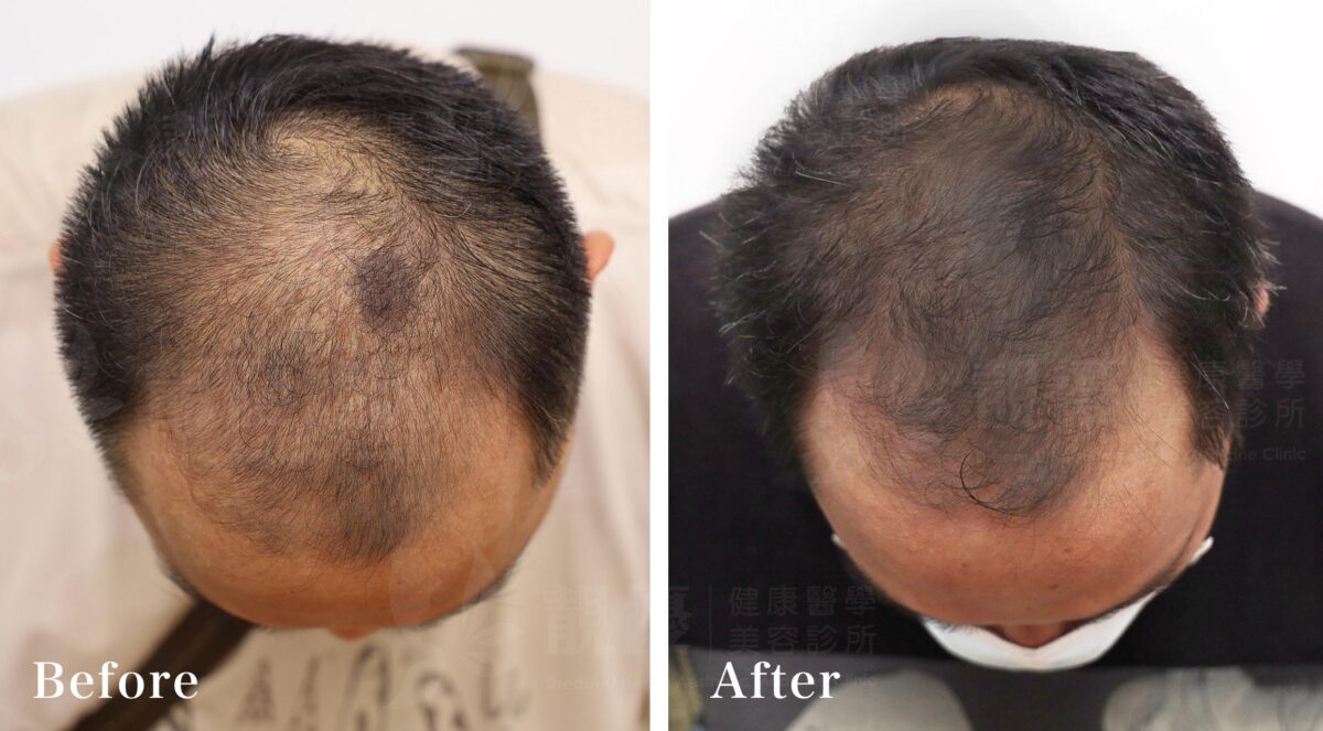 頭髮生長週期植髮雄性禿,靚優,質感醫美,台北推薦,東區醫美