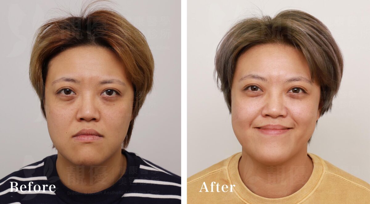 膠原蛋白,熊貓針,靚優,鄭嘉琪,醫美診所,靚優醫美,術前術後,台北推薦,東區醫美