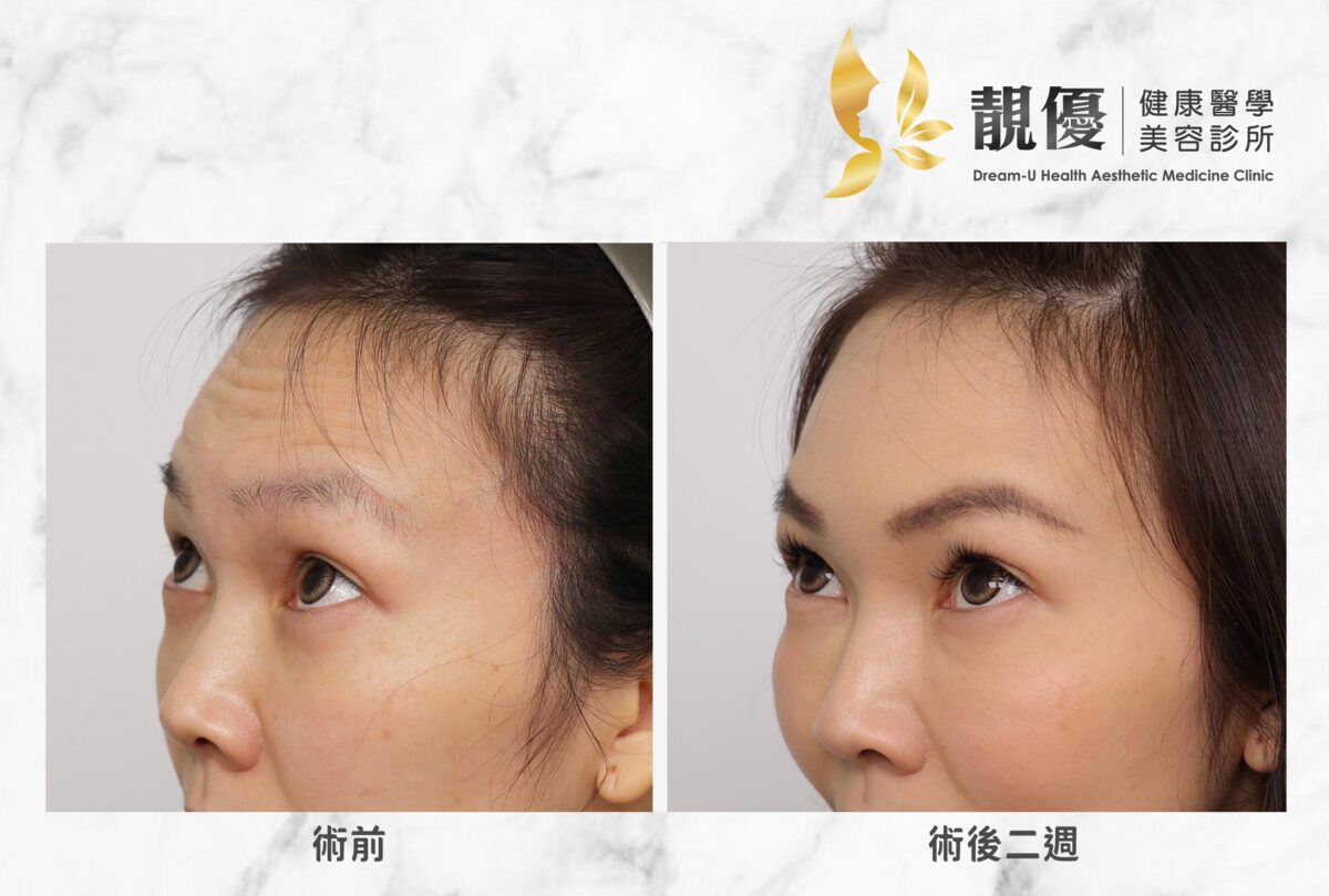 魚尾紋,皺眉紋,抬頭紋,儷緻,Dysport淨優明,Xeomin,保妥適,NABOTA,BOTOX,肉毒除皺,靚優,鄭嘉琪,醫美診所,靚優醫美,術前術後