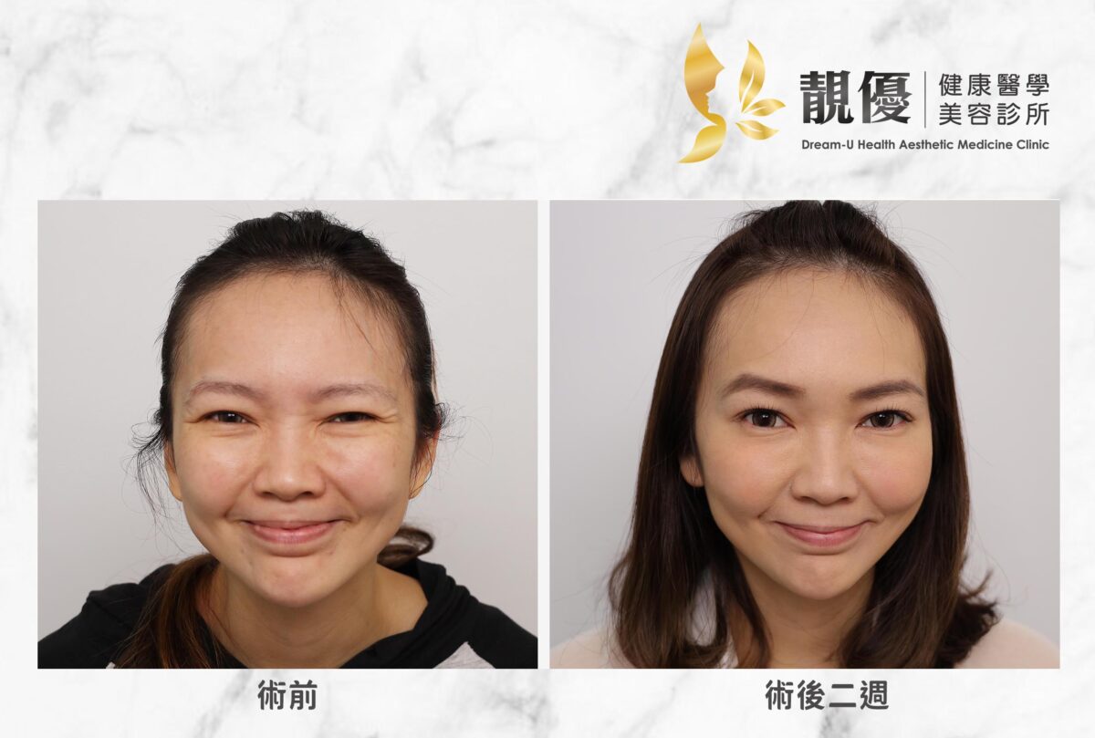 魚尾紋,皺眉紋,抬頭紋,儷緻,Dysport淨優明,Xeomin,保妥適,NABOTA,BOTOX,肉毒除皺,靚優,鄭嘉琪,醫美診所,靚優醫美,術前術後
