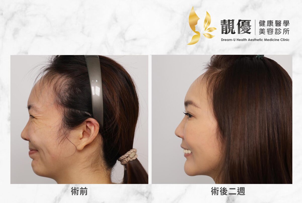 魚尾紋,皺眉紋,抬頭紋,儷緻,Dysport淨優明,Xeomin,保妥適,NABOTA,BOTOX,肉毒除皺,靚優,鄭嘉琪,醫美診所,靚優醫美,術前術後