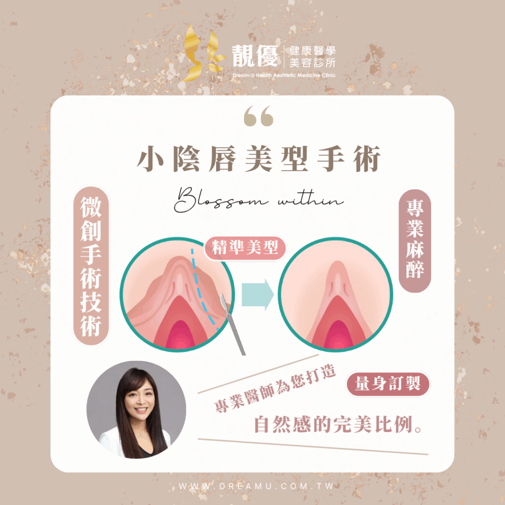 小陰唇美型私密美觀調整示意圖