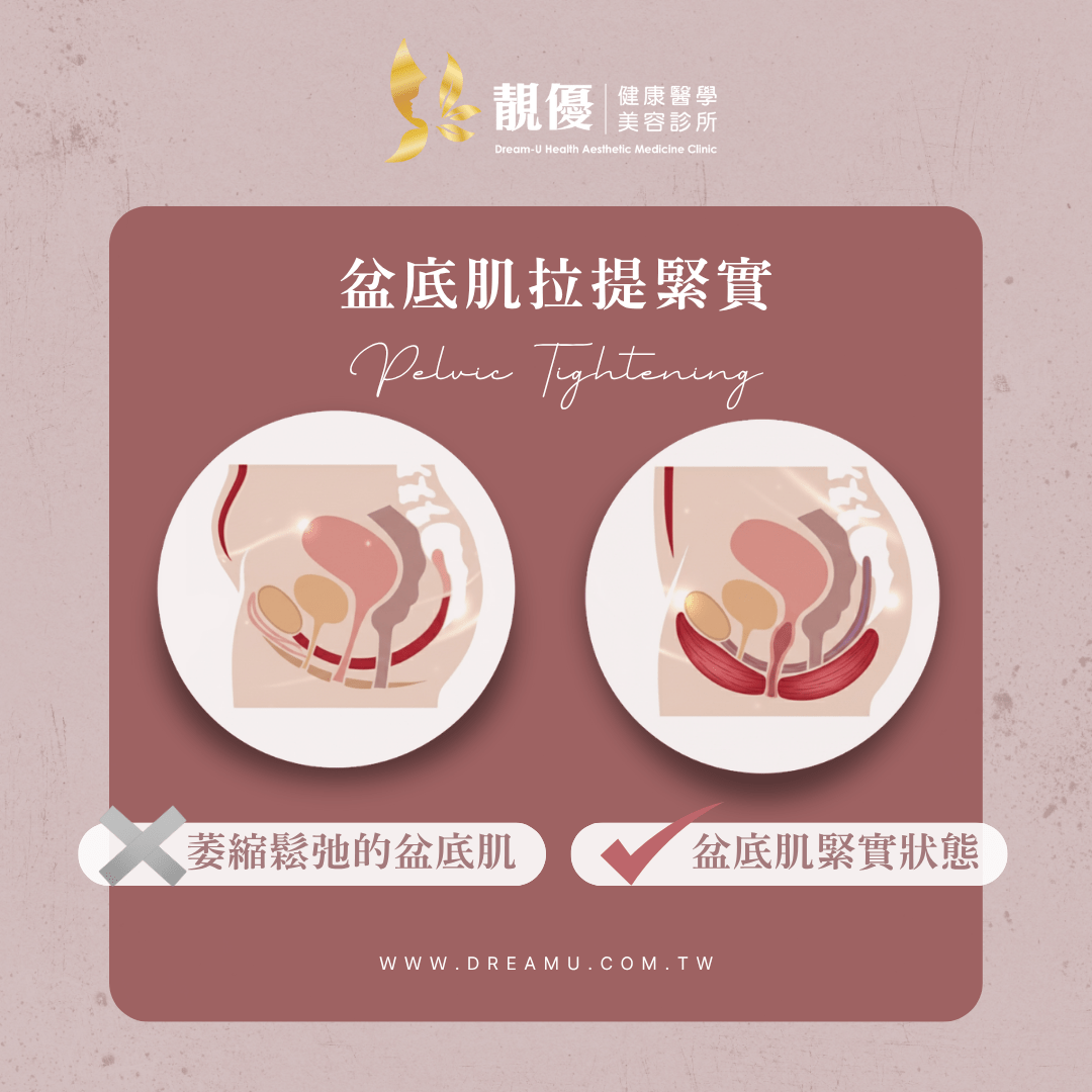 盆底肌緊實與修復拉提示意圖