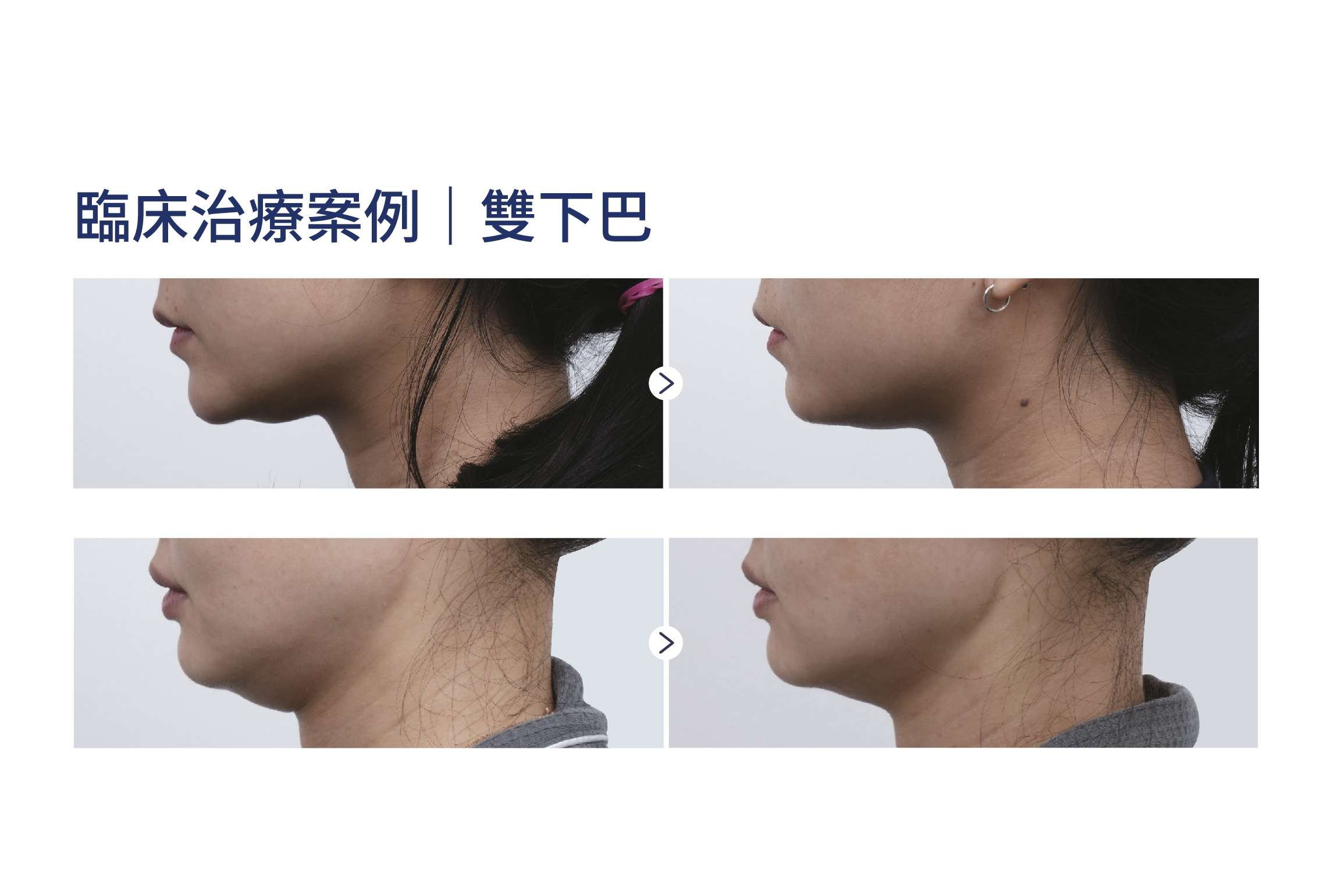 MPT 臨床實證案例一