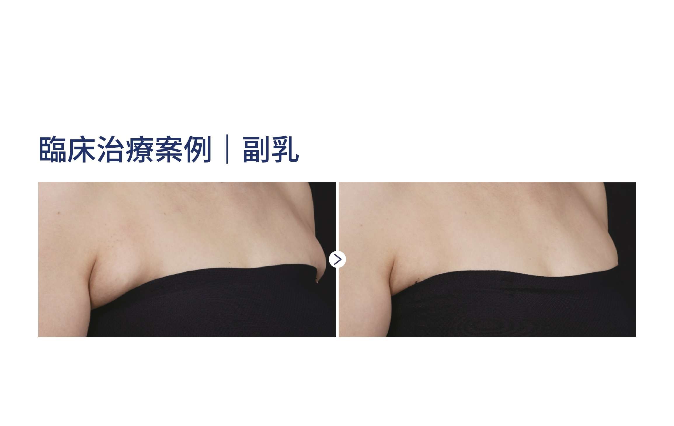 MPT 臨床實證案例二