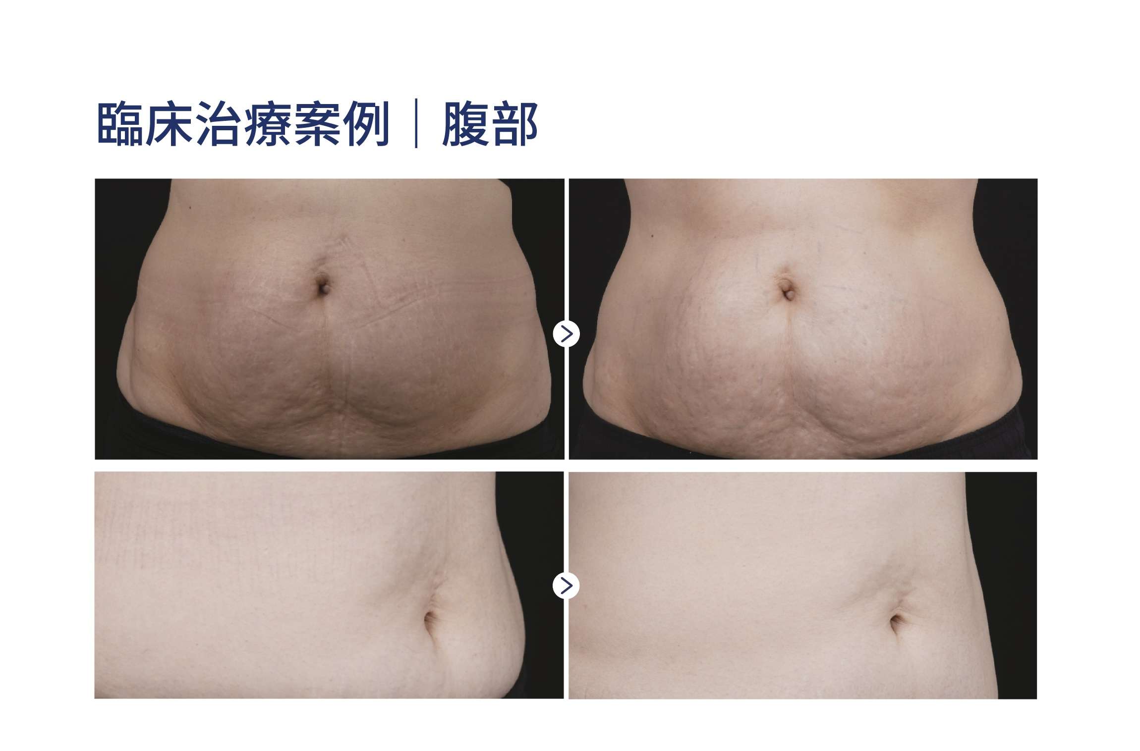 MPT 臨床實證案例三