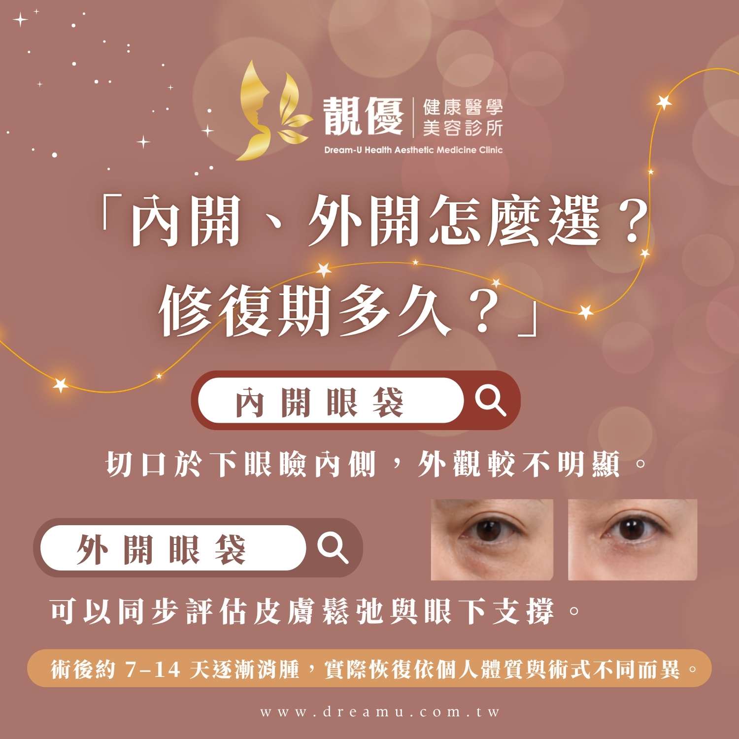 眼袋手術內開外開怎麼選