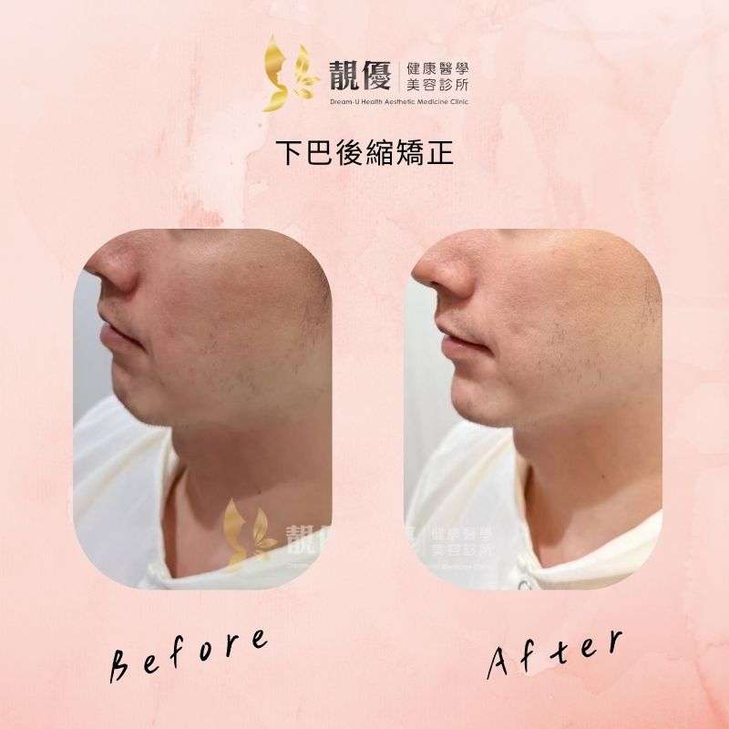 下巴成果