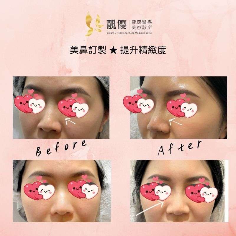 鼻雕成果